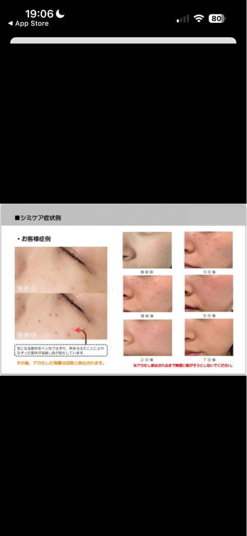 【未使用　新品】低周波シミ取り　ペンシルタイプ　業務用　セルフエステ　開業