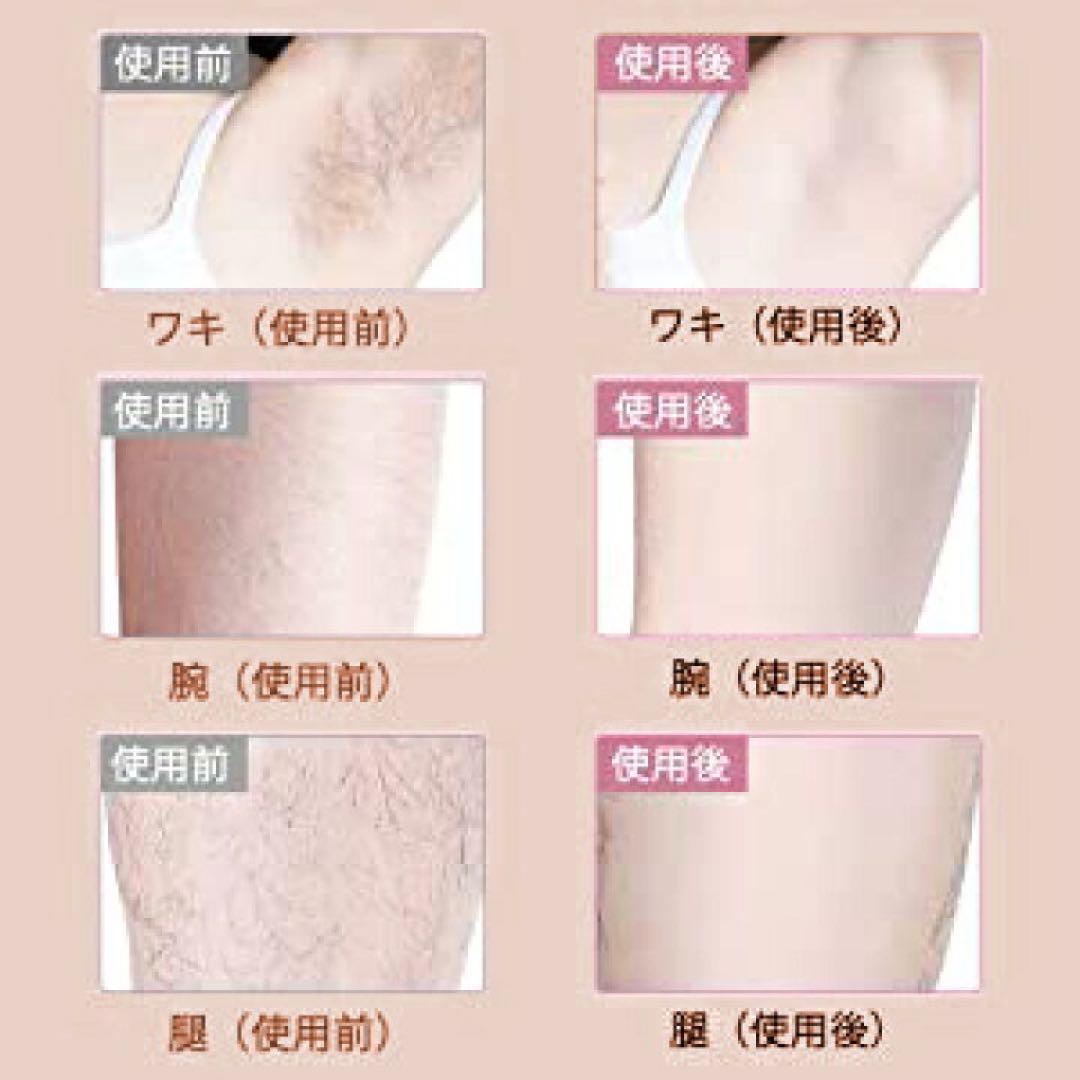 特別価格♥️脱毛器 サロン品質 光脱毛器 男女兼用 美肌機能 顔 全身 vio